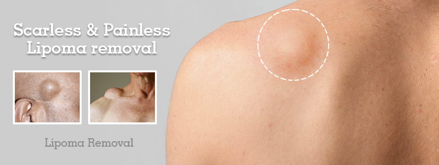 Best Lipoma Treatment In Thane