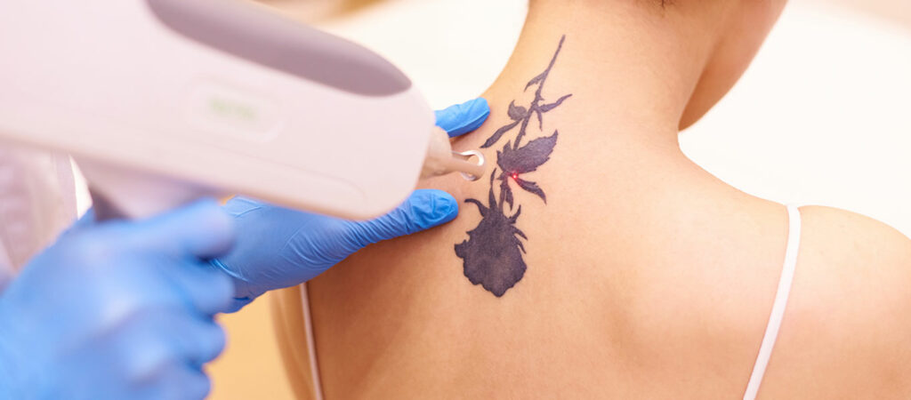 Laser Treatment For Tattoo Removal In Thane