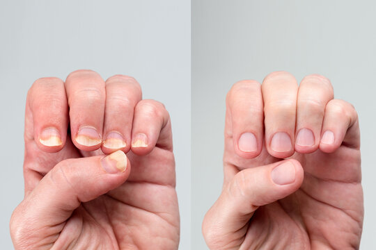 Nail Treatment Doctor in Thane - Dr Asha Mourya