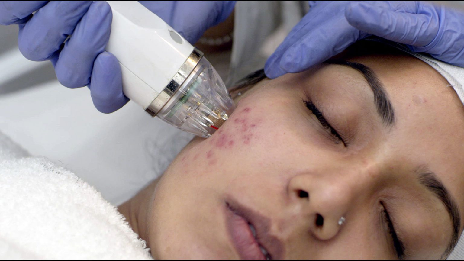 LASER & MNRF FOR ACNE SCAR