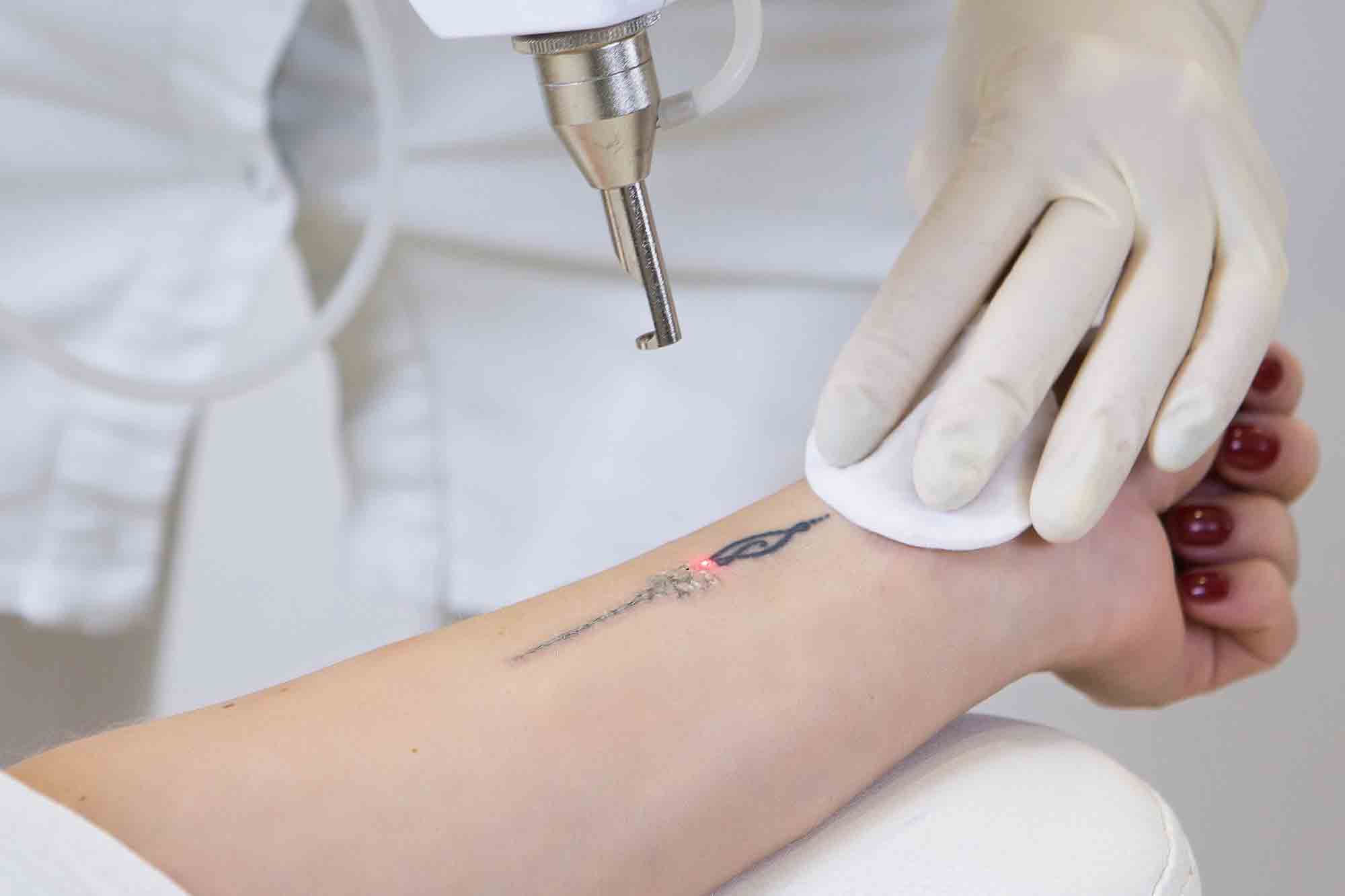 Laser Treatment For Tattoo Removal In Thane
