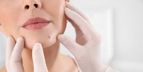 Best Lipoma And Cyst Excision Treatment In Thane