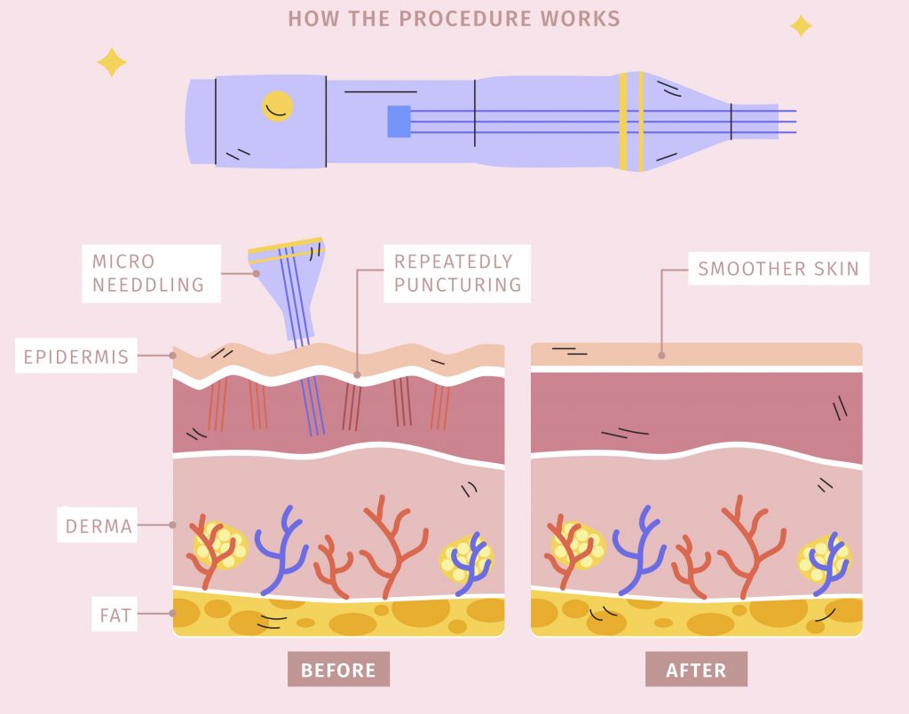 Best Doctors For RF Microneedling (MNRF) Treatment in Thane
