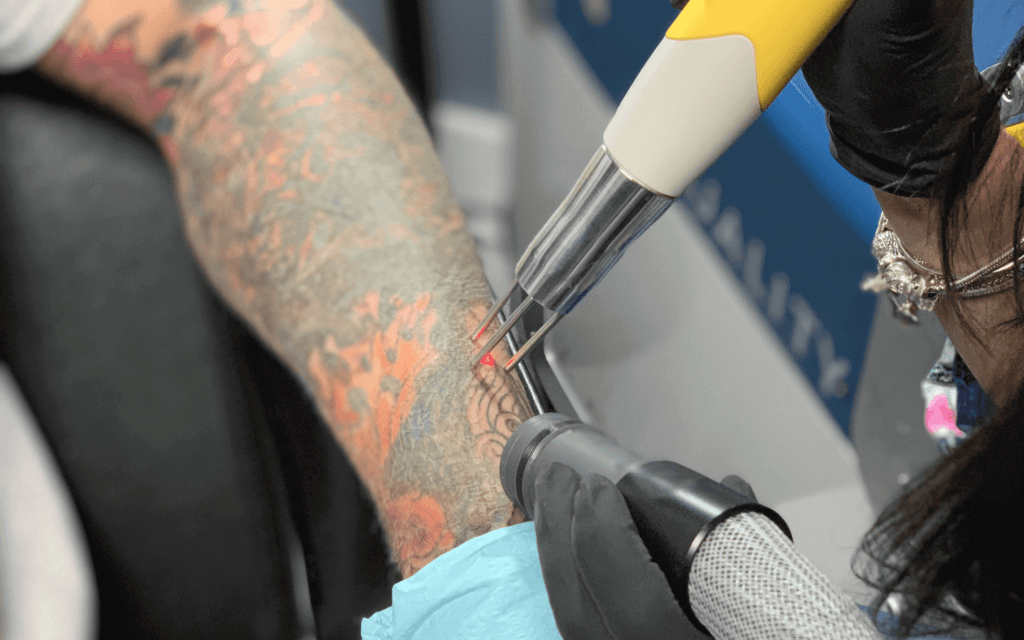 Laser Treatment For Tattoo Removal In Thane