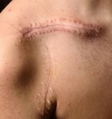 LASER & MNRF FOR ACNE SCAR in Thane