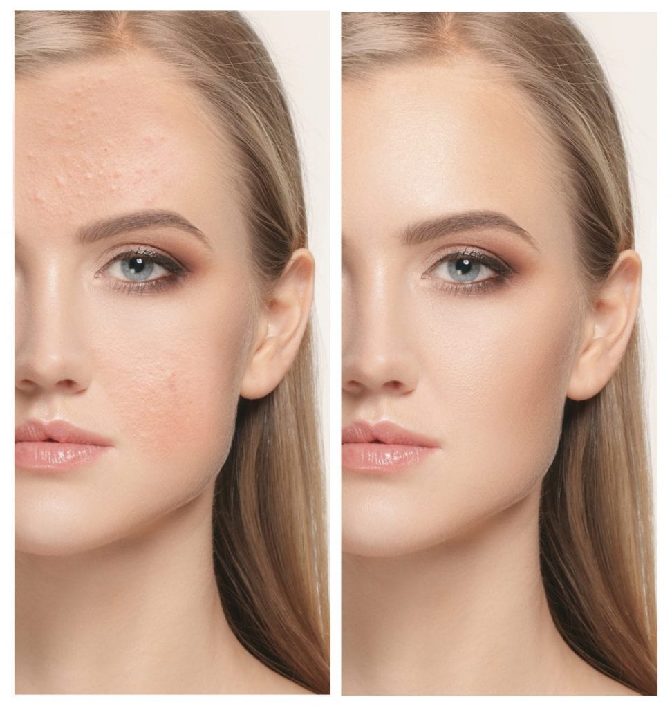Best Laser Toning for Pigmentation In Thane
