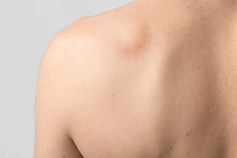 Lipoma Removal Surgery in Thane - Dr. Asha Mourya