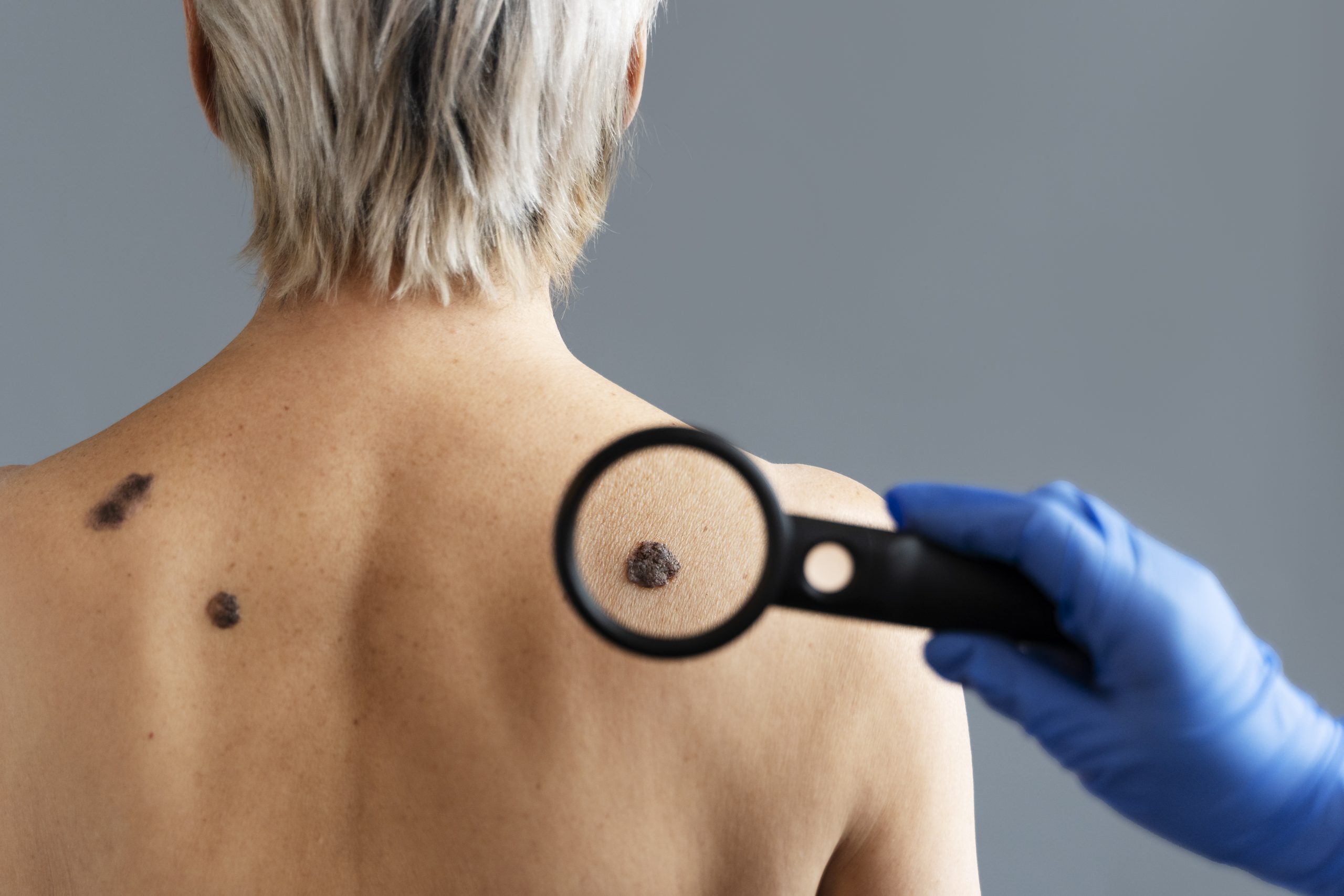 Skin Biopsy Procedure in Thane - Dr. Asha Mourya